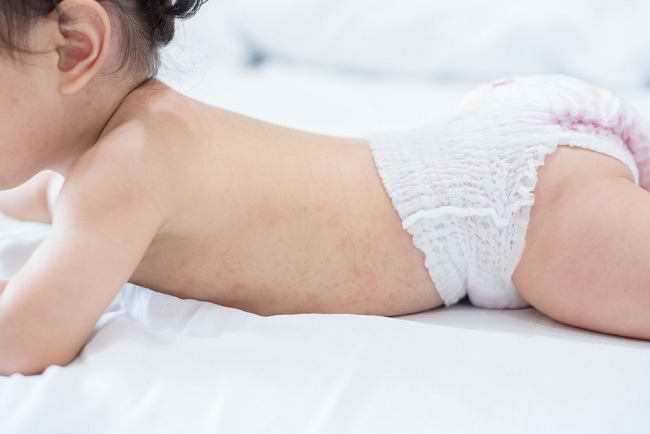 Jangan Sepelekan Biang Keringat pada Bayi