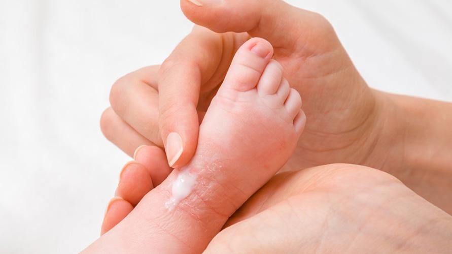 Waspadai Infeksi Jamur Pada Kulit Bayi Dimusim Hujan