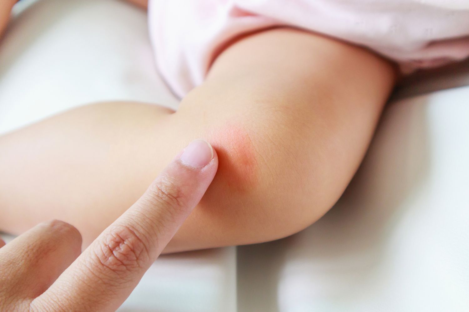 Cara Cepat Mengatasi Gatal Pada Kulit
