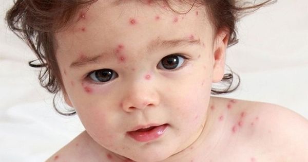 Hati-Hati! Ini 7 Penyebab Munculnya Bentol Berair pada Kulit Bayi