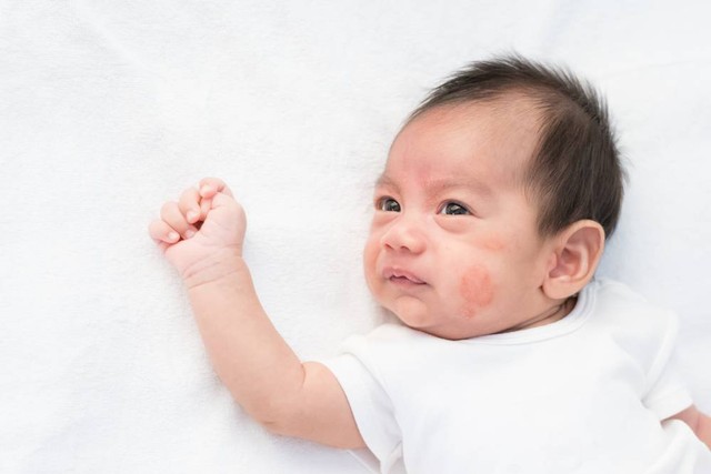 Cara Merawat Kulit Sensitif dan Alergi pada Bayi untuk Cegah Luka dan Bekasnya