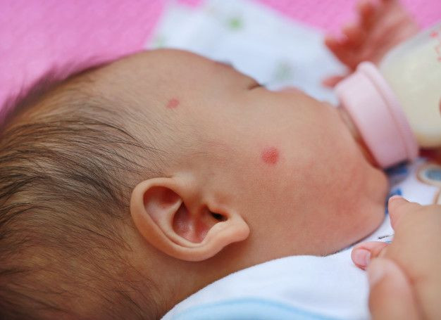 8 Penyakit yang Menimbulkan Bentol Berair pada Kulit Bayi