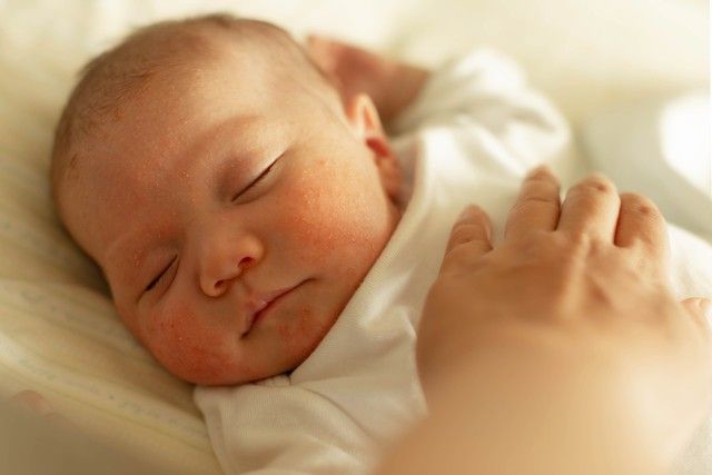 5 Jenis Ruam di Wajah Bayi dan Cara Mengatasinya yang Tepat