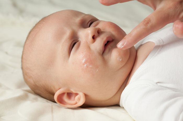 DERMATITIS ATOPIK BISA DICEGAH