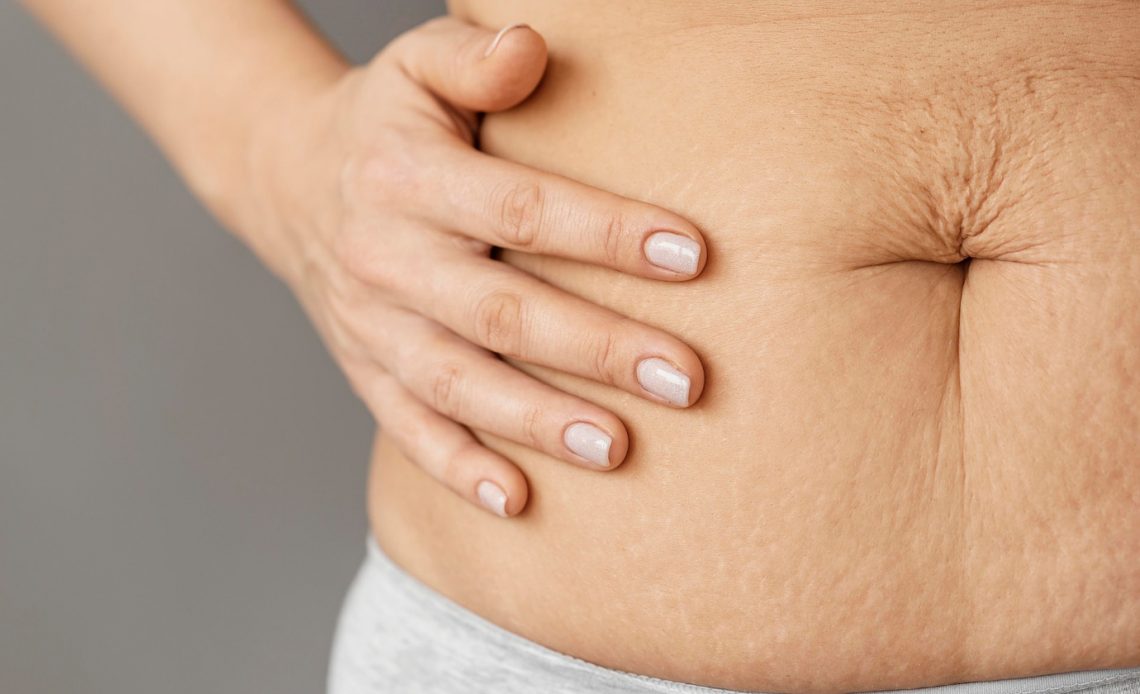 Ketahui Perbedaan Stretch Mark dan Selulit