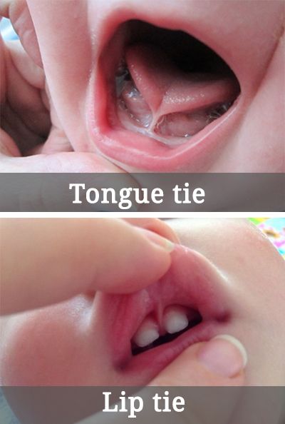 Mengenal Dampak Tongue-tie pada Bayi dan Cara Mengatasinya