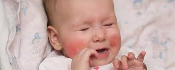 Penyebab Dermatitis pada Bayi dan Gejala yang Paling Umum Muncul