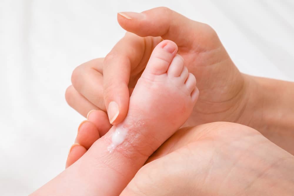 5 Masalah Kulit pada Bayi Prematur, Moms Perlu Tahu!