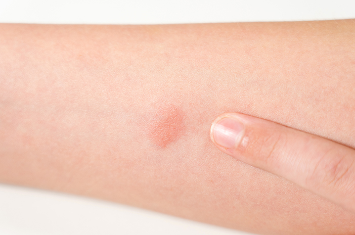 Test Mantoux Pada Anak, Apa Fungsinya?