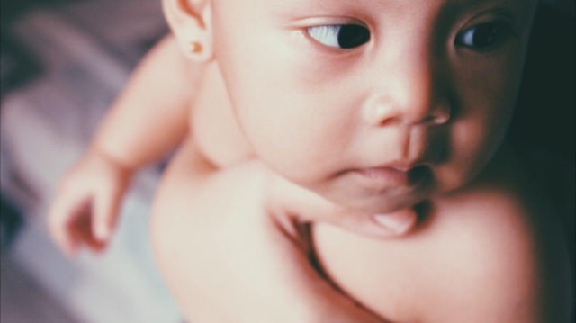 Penyebab Pityriasis Alba