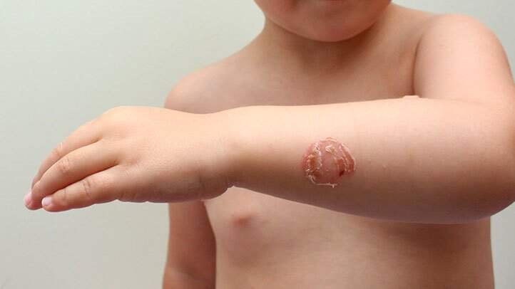 Simak Impetigo Yang Dapat Terjadi Pada Sikecil