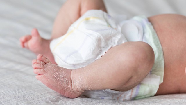 Kulit Bayi Bersisik karena Ibu Suka Minum Dingin saat Hamil, Mitos atau Fakta?