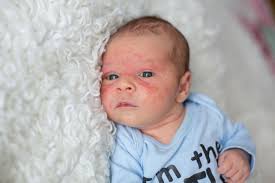 Bayi Rentan Terkena Dermatitis Kontak, Ini Sebabnya