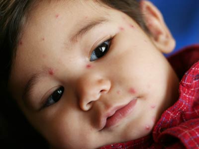 Apa yang Menyebabkan Herpes Anak?