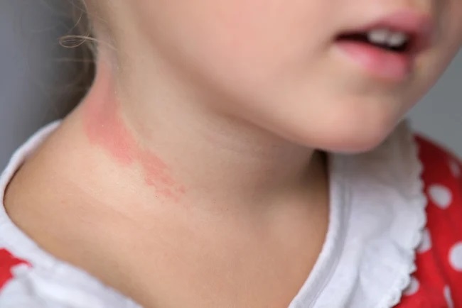 Penyebab Bercak Merah pada Kulit Anak Tanpa Demam
