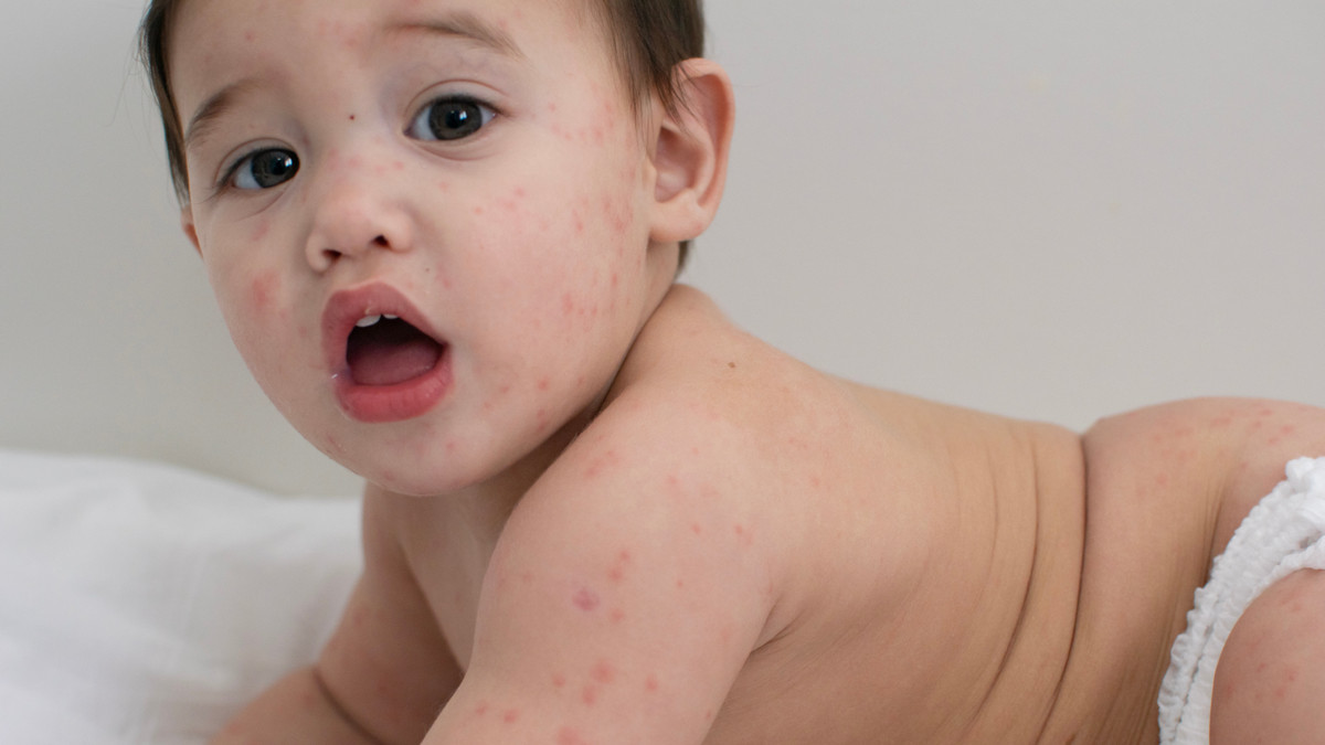 Moms, Wajib Tahu Beberapa Cacar Yang Bisa Menyerang Sikecil