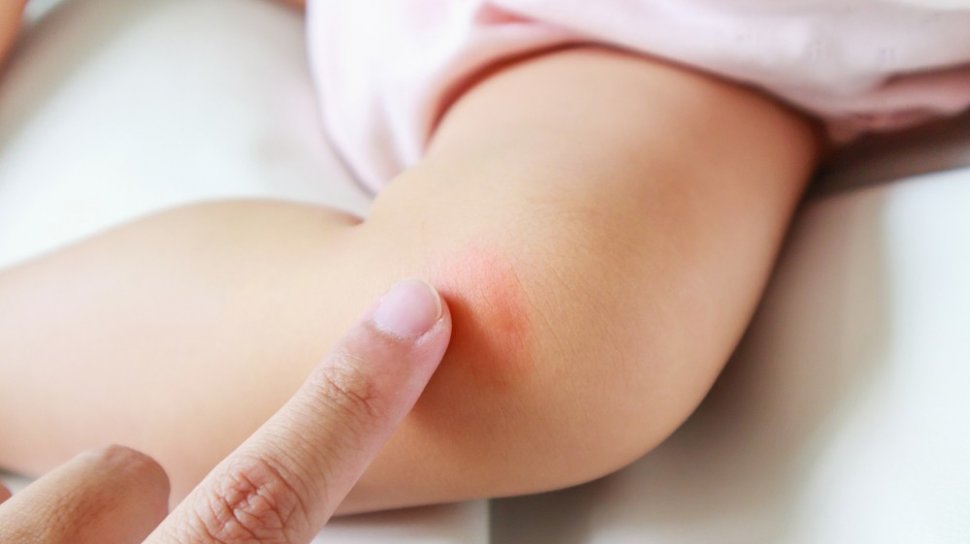 Pemicu Gatal Pada Kulit Dermatitis Atopik
