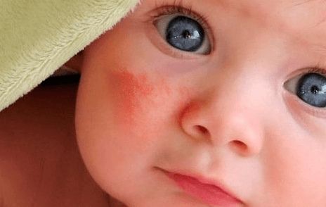 Pipi Bayi Merah-Merah? Belum Tentu Karena Alergi! Simak Penjelasannya