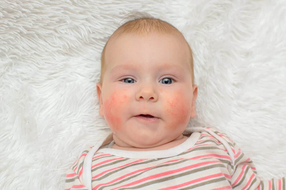 Ruam Pipi Bayi Bikin si Kecil Tak Nyaman, Apa Penyebabnya?