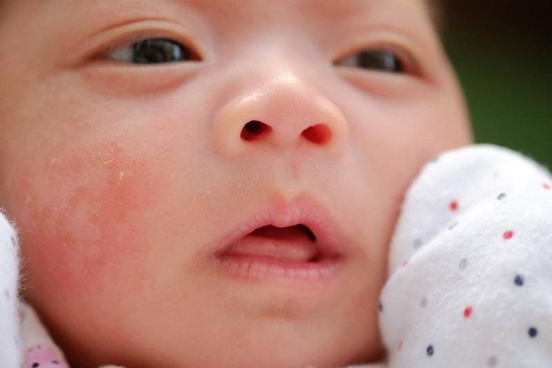 Penyebab Bruntusan Pada Kulit Bayi