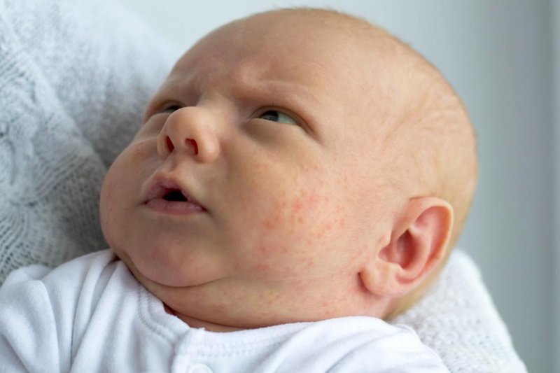 Ketahui 4 Tanda Kulit Bayi Sensitif Berikut Ini