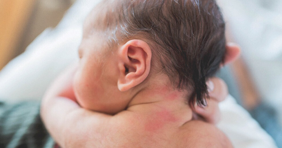 Birthmark atau tanda lahir, seperti apa sajakah jenisnya? Mari simak!