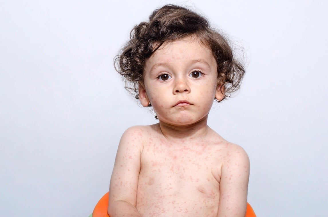 Ketika Sikecil Mengalami Campak, Apa Yang Perlu Moms Lakukan?