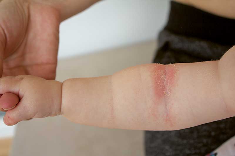 Area Paling Sering Terkena Dermatitis Atopik