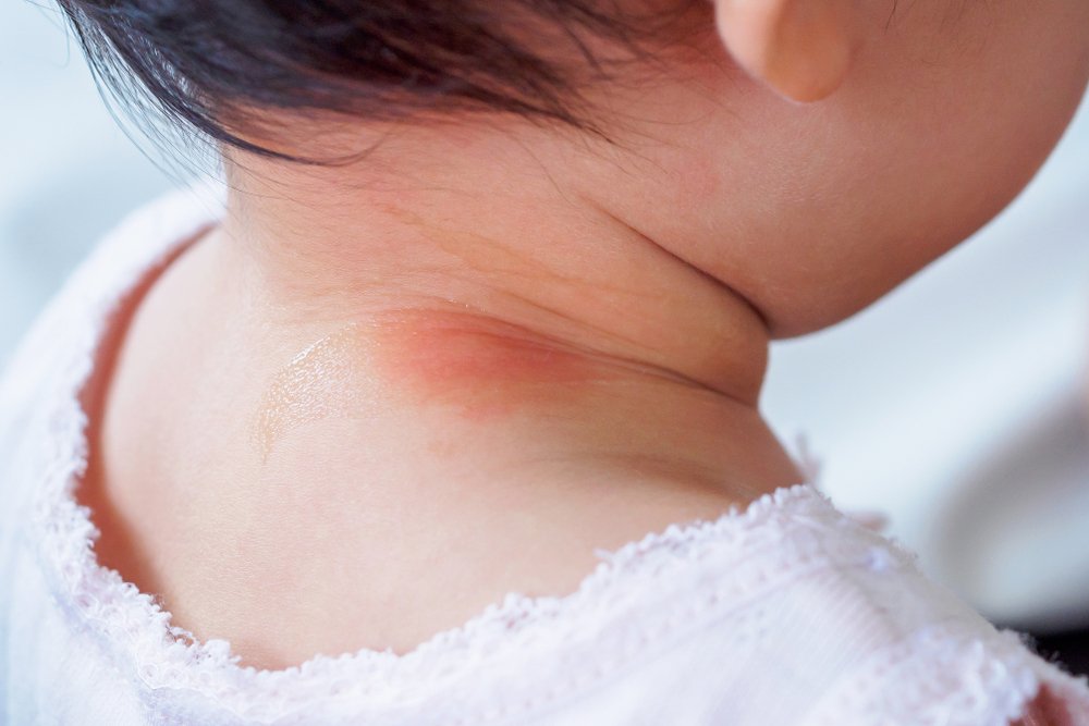 Leher Bayi Merah dan Lecet? Ini Penyebab dan Cara Mengatasinya