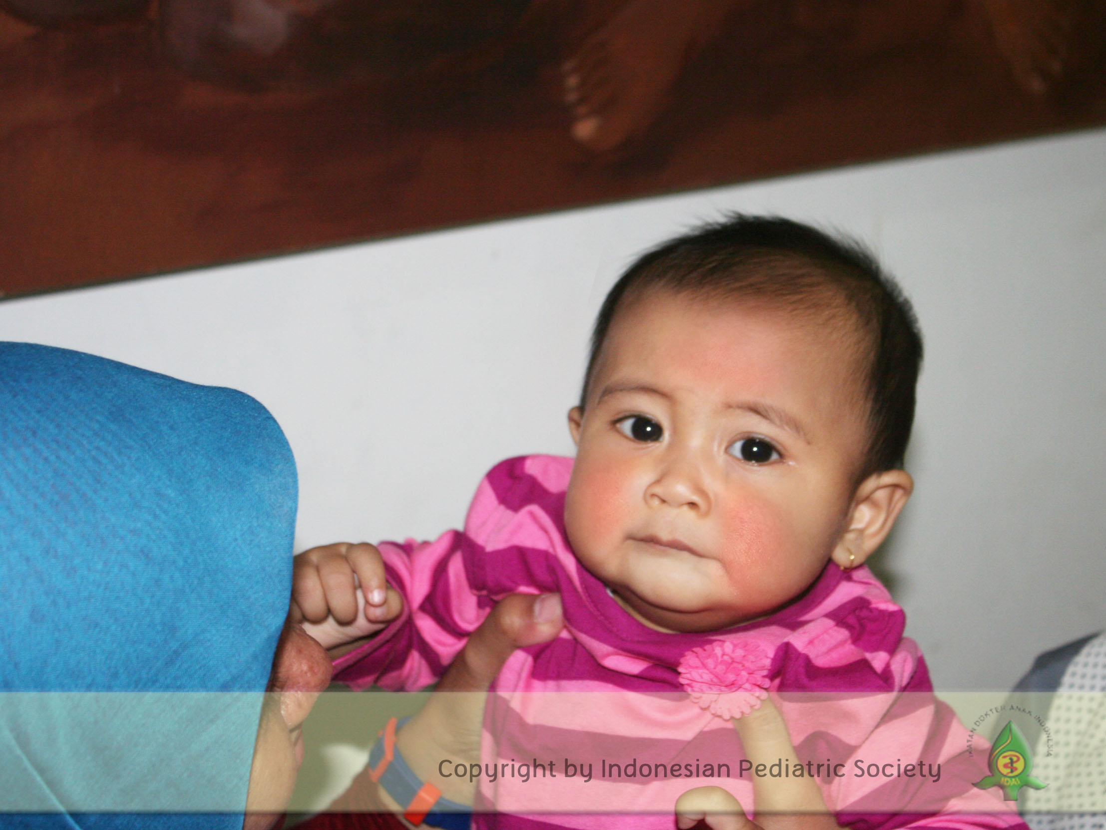Pentingnya Perawatan Kulit pada Anak dengan Dermatitis Atopik