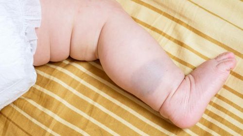 Hilangkan Tanda Lahir dengan Terapi Laser di Usia Anak-anak, Amankah?