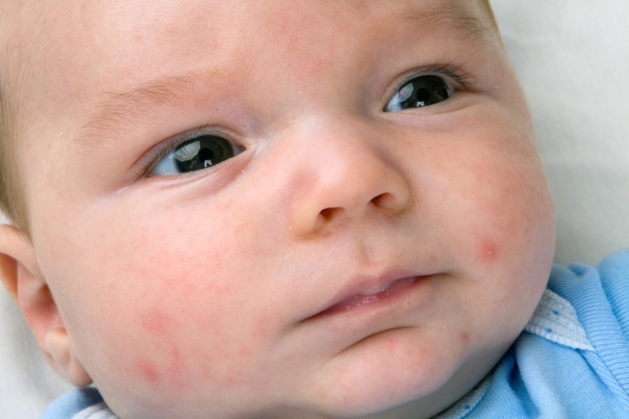 Mengobati ‘Jerawat’ Bayi