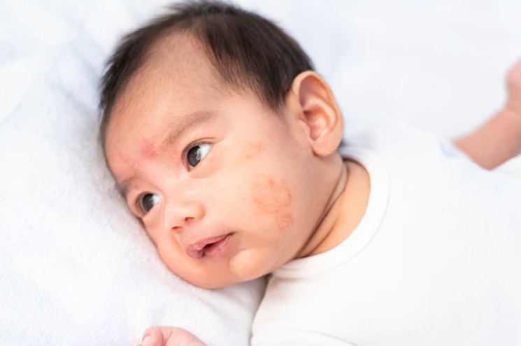 Mengenal Pityriasis Alba