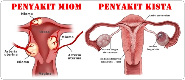 Perbedaan Kista Dan Miom
