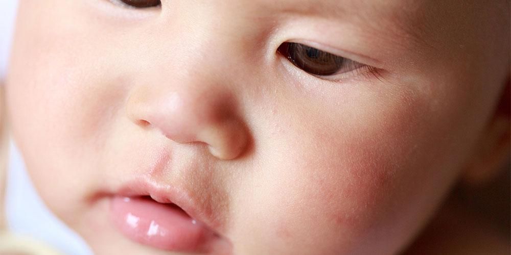 Bercak Putih pada Wajah Bayi Seperti Panu, Gejala Terjadinya Pityriasis Alba