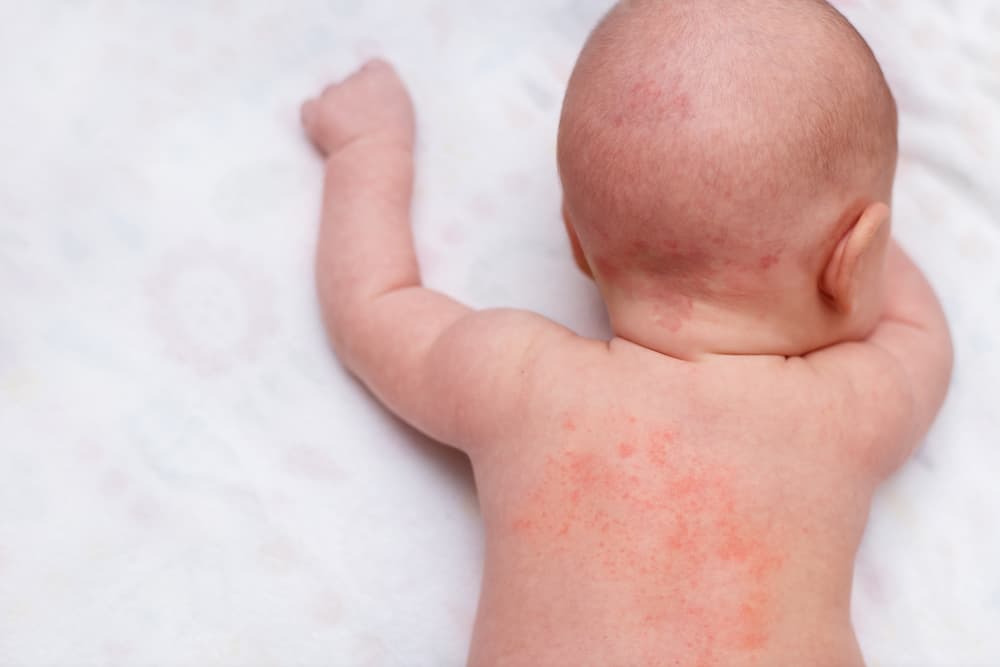 Bintik Merah Pada Kulit Bayi: Mana yang Wajar dan Mana yang Tidak?