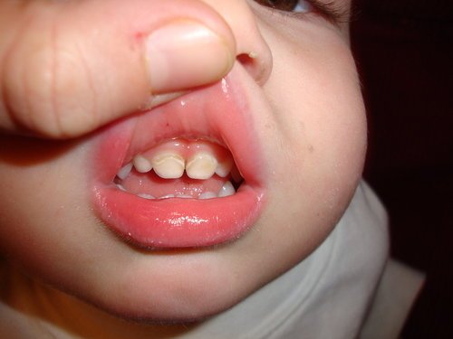 Penyebab Fluorosis Pada Gigi Anak