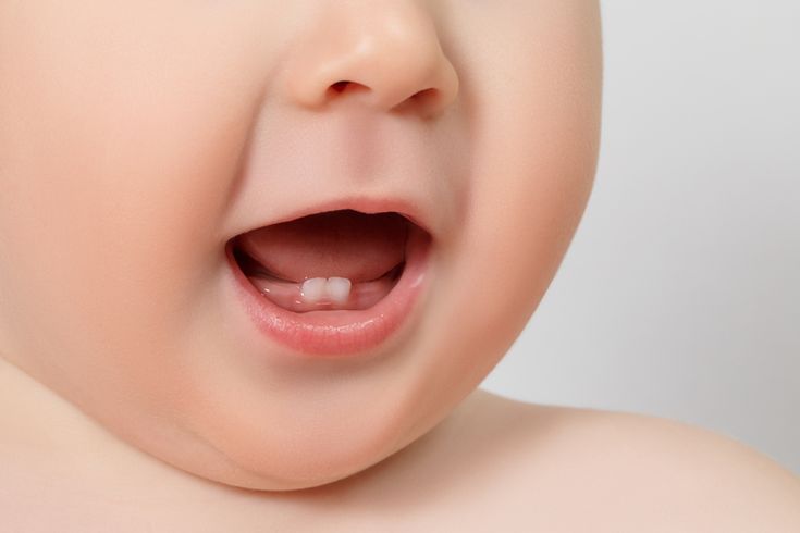 Adakah Komplikasi Akibat Baby Bottle Tooth Decay?