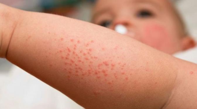 Penyakit Yang Di sebabkan Oleh Virus