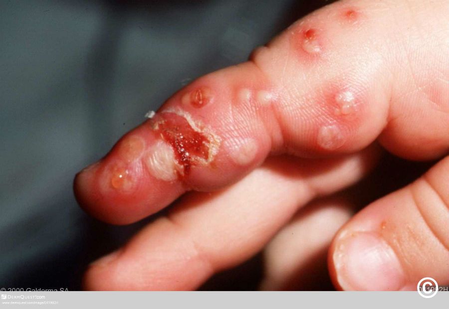 Apakah Herpes Bisa Menyerang Anak?