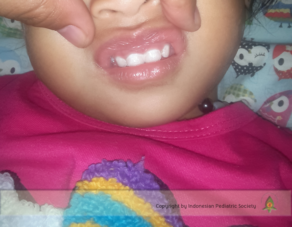 Stomatitis (Sariawan) pada Anak