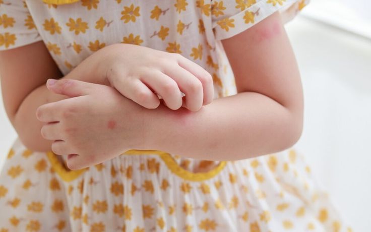 Gejala Campak pada Anak dan Cara Mengobatinya
