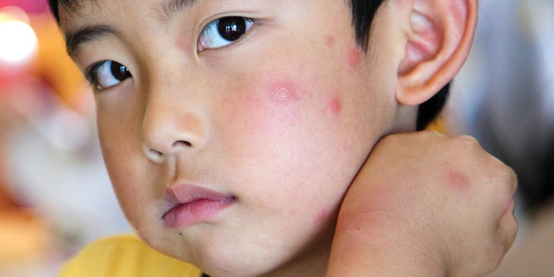 4 Penyakit Anak di Musim Hujan